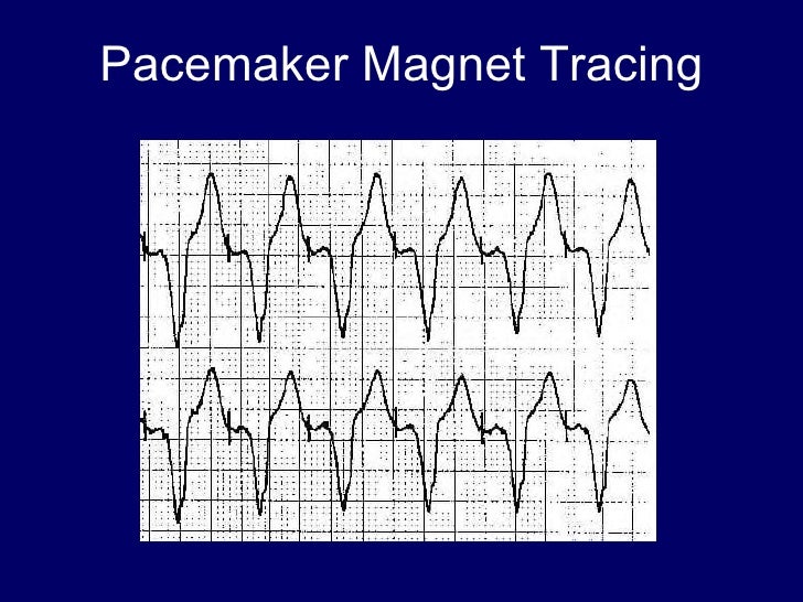 A D V A N C E D P A C I N G