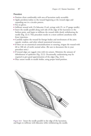 Chapter 22 | Suture Insertion 97
Procedure
● Position client comfortably with area of laceration easily accessible.
● Apply povidone-iodine to the wound beginning at the wound edges and
expanding out in a circular pattern.
● Put on gloves.
● Infiltrate wound with 1% lidocaine (5-mL syringe with 25- to 27-gauge needle).
● Insert the needle parallel along each side of the edge of the laceration to the
farthest point, and begin to infiltrate the wound while slowly withdrawing the
needle (Fig. 22.1). This procedure results in a more uniform anesthesia with
fewer injections.
● Carefully explore the wound for foreign bodies and involvement of the joint
capsule, tendons, and other related anatomical structures.
● If there are no anatomical contraindications to suturing, irrigate the wound with
60 to 100 mL of sterile normal saline. (Be sure to document this in your
procedure note.)
● If wound edges are ragged, trim with iris scissors. Minimize the amount of
debridement of epidermis (Fig. 22.2). Occasionally, undermining may be
required to give good approximation of the edges (Fig. 22.3).
● Place suture needle in needle holder, using proper hand position.
Figure 22.1 Insert the needle parallel to the edge of the laceration,
and begin to infiltrate with lidocaine while withdrawing the needle.
4206_Chapter 1_0001-0120.indd 974206_Chapter 1_0001-0120.indd 97 12/24/2014 2:01:19 PM12/24/2014 2:01:19 PM
Process CyanProcess CyanProcess MagentaProcess MagentaProcess YellowProcess YellowProcess BlackProcess Black
 