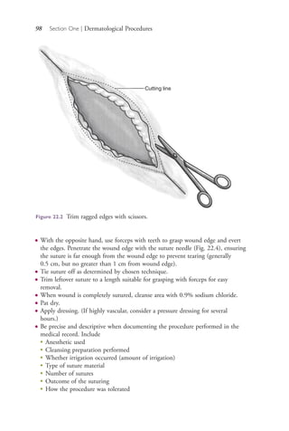 98 Section One | Dermatological Procedures
Cutting line
Figure 22.2 Trim ragged edges with scissors.
● With the opposite hand, use forceps with teeth to grasp wound edge and evert
the edges. Penetrate the wound edge with the suture needle (Fig. 22.4), ensuring
the suture is far enough from the wound edge to prevent tearing (generally
0.5 cm, but no greater than 1 cm from wound edge).
● Tie suture off as determined by chosen technique.
● Trim leftover suture to a length suitable for grasping with forceps for easy
removal.
● When wound is completely sutured, cleanse area with 0.9% sodium chloride.
● Pat dry.
● Apply dressing. (If highly vascular, consider a pressure dressing for several
hours.)
● Be precise and descriptive when documenting the procedure performed in the
medical record. Include
●
Anesthetic used
●
Cleansing preparation performed
●
Whether irrigation occurred (amount of irrigation)
●
Type of suture material
●
Number of sutures
●
Outcome of the suturing
●
How the procedure was tolerated
4206_Chapter 1_0001-0120.indd 984206_Chapter 1_0001-0120.indd 98 12/24/2014 2:01:19 PM12/24/2014 2:01:19 PM
Process CyanProcess CyanProcess MagentaProcess MagentaProcess YellowProcess YellowProcess BlackProcess Black
 