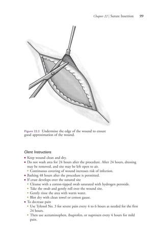Chapter 22 | Suture Insertion 99
Client Instructions
● Keep wound clean and dry.
● Do not wash area for 24 hours after the procedure. After 24 hours, dressing
may be removed, and site may be left open to air.
●
Continuous covering of wound increases risk of infection.
● Bathing 48 hours after the procedure is permitted.
● If crust develops over the sutured site
●
Cleanse with a cotton-tipped swab saturated with hydrogen peroxide.
●
Take the swab and gently roll over the wound site.
●
Gently rinse the area with warm water.
●
Blot dry with clean towel or cotton gauze.
● To decrease pain
●
Use Tylenol No. 3 for severe pain every 4 to 6 hours as needed for the first
24 hours.
●
Then use acetaminophen, ibuprofen, or naproxen every 4 hours for mild
pain.
Figure 22.3 Undermine the edge of the wound to ensure
good approximation of the wound.
4206_Chapter 1_0001-0120.indd 994206_Chapter 1_0001-0120.indd 99 12/24/2014 2:01:19 PM12/24/2014 2:01:19 PM
Process CyanProcess CyanProcess MagentaProcess MagentaProcess YellowProcess YellowProcess BlackProcess Black
 