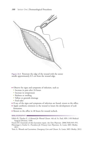 100 Section One | Dermatological Procedures
● Observe for signs and symptoms of infection, such as
● Increase in pain after 24 hours
● Increase in temperature
● Redness or swelling
● Yellow or greenish drainage
●
Foul odor
● If any of the signs and symptoms of infection are found, return to the office.
● Apply antibiotic ointment to the wound to lessen the development of scab
formation.
● Return to the office in 48 hours for wound recheck.
BIBLIOGRAPHY
Edlich R, Thacker E. A Manual for Wound Closure. 4th ed. St. Paul, MN: 3-M Medical-
Surgical Division; 1990.
Forsch RT. Essentials of skin laceration repair. Am Fam Physician. 2008;78(8):945–951.
Pfenninger J, Fowler G. Procedures for Primary Care Physicians. St. Louis, MO: Mosby;
2011.
Trott A. Wounds and Lacerations: Emergency Care and Closure. St. Louis, MO: Mosby; 2012.
Figure 22.4 Penetrate the edge of the wound with the suture
needle approximately 0.5 cm from the wound edge.
4206_Chapter 1_0001-0120.indd 1004206_Chapter 1_0001-0120.indd 100 12/24/2014 2:01:19 PM12/24/2014 2:01:19 PM
Process CyanProcess CyanProcess MagentaProcess MagentaProcess YellowProcess YellowProcess BlackProcess Black
 