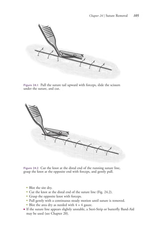 Chapter 24 | Suture Removal 105
●
Blot the site dry.
●
Cut the knot at the distal end of the suture line (Fig. 24.2).
●
Grasp the opposite knot with forceps.
●
Pull gently with a continuous steady motion until suture is removed.
●
Blot the area dry as needed with 4 × 4 gauze.
● If the suture line appears slightly unstable, a Steri-Strip or butterfly Band-Aid
may be used (see Chapter 20).
Figure 24.1 Pull the suture tail upward with forceps, slide the scissors
under the suture, and cut.
Figure 24.2 Cut the knot at the distal end of the running suture line,
grasp the knot at the opposite end with forceps, and gently pull.
4206_Chapter 1_0001-0120.indd 1054206_Chapter 1_0001-0120.indd 105 12/24/2014 2:01:19 PM12/24/2014 2:01:19 PM
Process CyanProcess CyanProcess MagentaProcess MagentaProcess YellowProcess YellowProcess BlackProcess Black
 