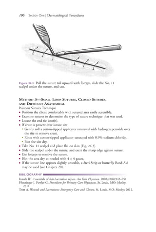 106 Section One | Dermatological Procedures
METHOD 3—SMALL LOOP SUTURES, CLOSED SUTURES,
AND DIFFICULT ANATOMICAL
Position Sutures Technique
● Position the client comfortably with sutured area easily accessible.
● Examine sutures to determine the type of suture technique that was used.
● Locate the end tie knot(s).
● If crust is present over suture site
●
Gently roll a cotton-tipped applicator saturated with hydrogen peroxide over
the site to remove crust.
●
Rinse with cotton-tipped applicator saturated with 0.9% sodium chloride.
●
Blot the site dry.
● Take No. 11 scalpel and place flat on skin (Fig. 24.3).
● Slide the scalpel under the suture, and exert the sharp edge against suture.
● Use forceps to remove the suture.
● Blot the area dry as needed with 4 × 4 gauze.
● If the suture line appears slightly unstable, a Steri-Strip or butterfly Band-Aid
may be used (see Chapter 20).
BIBLIOGRAPHY
Forsch RT. Essentials of skin laceration repair. Am Fam Physician. 2008;78(8):945–951.
Pfenninger J, Fowler G. Procedures for Primary Care Physicians. St. Louis, MO: Mosby;
2011.
Trott A. Wounds and Lacerations: Emergency Care and Closure. St. Louis, MO: Mosby; 2012.
Figure 24.3 Pull the suture tail upward with forceps, slide the No. 11
scalpel under the suture, and cut.
4206_Chapter 1_0001-0120.indd 1064206_Chapter 1_0001-0120.indd 106 12/24/2014 2:01:19 PM12/24/2014 2:01:19 PM
Process CyanProcess CyanProcess MagentaProcess MagentaProcess YellowProcess YellowProcess BlackProcess Black
 