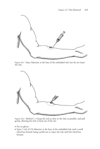 Chapter 25 | Tick Removal 111
Figure 25.1 Inject lidocaine at the base of the embedded tick, but do not inject
the tick.
Figure 25.2 Method 1—Grasp the tick as close to the skin as possible, and pull
gently, allowing the tick to back out of the site.
● Put on gloves.
● Inject 1 mL of 1% lidocaine at the base of the embedded tick until a small
wheal has formed, being careful not to inject the tick until the wheal has
formed.
4206_Chapter 1_0001-0120.indd 1114206_Chapter 1_0001-0120.indd 111 12/24/2014 2:01:20 PM12/24/2014 2:01:20 PM
Process CyanProcess CyanProcess MagentaProcess MagentaProcess YellowProcess YellowProcess BlackProcess Black
 