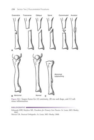 134 Section Two | Musculoskeletal Procedures
Figure 30.2 Inspect bones for (A) continuity, (B) size and shape, and (C) soft
tissue inflammation.
BIBLIOGRAPHY
Edmunds MW, Mayhew MS. Procedures for Primary Care Practice. St. Louis, MO: Mosby;
2002.
Mercier LR. Practical Orthopedics. St. Louis, MO: Mosby; 2008.
Greenstick Transverse Oblique Spiral Comminuted Avulsion
A
Abnormal NormalB
Abnormal
outpouching
C
4206_Chapter 2_0121-0204.indd 1344206_Chapter 2_0121-0204.indd 134 12/24/2014 2:01:27 PM12/24/2014 2:01:27 PM
Process CyanProcess CyanProcess MagentaProcess MagentaProcess YellowProcess YellowProcess BlackProcess Black
 