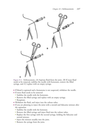 Chapter 31 | Arthrocentesis 137
● If blood is aspirated and a hematoma is not suspected, withdraw the needle.
● If more fluid needs to be removed
●
Stabilize the needle with the hemostats.
●
Remove the filled syringe and replace with an empty syringe.
●
Reaspirate.
● Withdraw the fluid, and inject into the culture tubes.
● If you are planning to inject the joint with a steroid and lidocaine mixture after
the aspiration
●
Stabilize the needle with the hemostat.
●
Remove the filled syringe and inject fluid into the culture tubes.
●
Replace the first syringe with the second syringe, holding the lidocaine and
steroid mixture.
●
Inject the mixture steadily into the joint.
●
Remove the syringe from the joint.
Figure 31.1 Arthrocentesis. (A) Aspirate fluid from the joint. (B) If more fluid
needs to be removed, stabilize the needle with hemostats, remove the filled
syringe, and (C) replace with an empty syringe.
A
B
C
4206_Chapter 2_0121-0204.indd 1374206_Chapter 2_0121-0204.indd 137 12/25/2014 4:46:43 PM12/25/2014 4:46:43 PM
Process CyanProcess CyanProcess MagentaProcess MagentaProcess YellowProcess YellowProcess BlackProcess Black
 