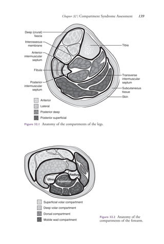 Chapter 32 | Compartment Syndrome Assessment 139
Deep (crural)
fascia
Fibula
Anterior
intermuscular
septum
Interosseous
membrane
Posterior
intermuscular
septum
Skin
Subcutaneous
tissue
Tibia
Transverse
intermuscular
septum
Anterior
Lateral
Posterior deep
Posterior superficial
Figure 32.1 Anatomy of the compartments of the legs.
Supinator
Superficial volar compartment
Deep volar compartment
Dorsal compartment
Mobile wad compartment
Ulna
Radius
Figure 32.2 Anatomy of the
compartments of the forearm.
4206_Chapter 2_0121-0204.indd 1394206_Chapter 2_0121-0204.indd 139 12/24/2014 2:01:28 PM12/24/2014 2:01:28 PM
Process CyanProcess CyanProcess MagentaProcess MagentaProcess YellowProcess YellowProcess BlackProcess Black
 