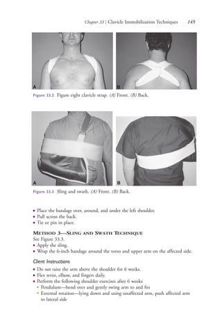 Chapter 33 | Clavicle Immobilization Techniques 145
● Place the bandage over, around, and under the left shoulder.
● Pull across the back.
● Tie or pin in place.
METHOD 3—SLING AND SWATH TECHNIQUE
See Figure 33.3.
● Apply the sling.
● Wrap the 6-inch bandage around the torso and upper arm on the affected side.
Client Instructions
● Do not raise the arm above the shoulder for 6 weeks.
● Flex wrist, elbow, and fingers daily.
● Perform the following shoulder exercises after 6 weeks
● Pendulum—bend over and gently swing arm to and fro
● External rotation—lying down and using unaffected arm, push affected arm
to lateral side
Figure 33.2 Figure eight clavicle strap. (A) Front. (B) Back.
A B
A B
Figure 33.3 Sling and swath. (A) Front. (B) Back.
4206_Chapter 2_0121-0204.indd 1454206_Chapter 2_0121-0204.indd 145 12/24/2014 2:01:28 PM12/24/2014 2:01:28 PM
Process CyanProcess CyanProcess MagentaProcess MagentaProcess YellowProcess YellowProcess BlackProcess Black
 