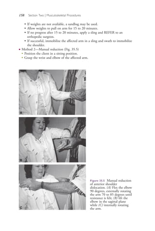 158 Section Two | Musculoskeletal Procedures
• If weights are not available, a sandbag may be used.
• Allow weights to pull on arm for 15 to 20 minutes.
• If no progress after 15 to 20 minutes, apply a sling and REFER to an
orthopedic surgeon.
• If successful, immobilize the affected arm in a sling and swath to immobilize
the shoulder.
● Method 2—Manual reduction (Fig. 35.5)
●
Position the client in a sitting position.
●
Grasp the wrist and elbow of the affected arm.
Figure 35.5 Manual reduction
of anterior shoulder
dislocation. (A) Flex the elbow
90 degrees, externally rotating
the arm 70 to 85 degrees until
resistance is felt; (B) lift the
elbow in the sagittal plane
while (C) internally rotating
the arm.
A
B
C
4206_Chapter 2_0121-0204.indd 1584206_Chapter 2_0121-0204.indd 158 12/24/2014 2:01:29 PM12/24/2014 2:01:29 PM
Process CyanProcess CyanProcess MagentaProcess MagentaProcess YellowProcess YellowProcess BlackProcess Black
 