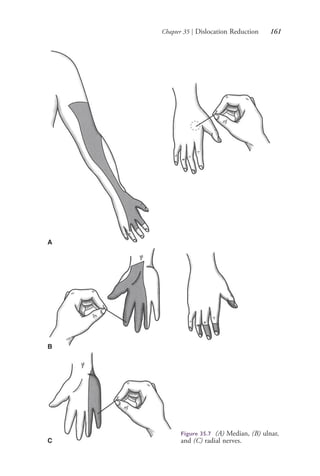 Chapter 35 | Dislocation Reduction 161
Figure 35.7 (A) Median, (B) ulnar,
and (C) radial nerves.
A
B
C
4206_Chapter 2_0121-0204.indd 1614206_Chapter 2_0121-0204.indd 161 12/24/2014 2:01:30 PM12/24/2014 2:01:30 PM
Process CyanProcess CyanProcess MagentaProcess MagentaProcess YellowProcess YellowProcess BlackProcess Black
 