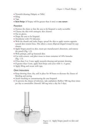 Chapter 1 | Punch Biopsy 3
● Nonstick dressing (Adaptic or Telfa)
● Kling
● Tape
● Steri-Strips (if biopsy will be greater than 4 mm) or one suture
Procedure
● Position the client so that the area to be biopsied is easily accessible.
● Cleanse the skin with antiseptic skin cleanser.
● Put on gloves.
● Drape the area to be biopsied.
● Anesthetize with 1% lidocaine.
● With the thumb and index finger, spread the skin to apply tension opposite
natural skin tension lines. This allows a more elliptical-shaped wound for easy
closure.
● Apply biopsy punch to skin, rotate per manufacturer’s directions, and remove
the punch (Fig. 1.2).
● With pickups, pull up loosened skin.
● Cut with scissors, and place tissue in tissue container of 10% formalin
(Fig. 1.3).
● If less than 2 to 3 mm, apply nonstick dressing and pressure dressing.
● If greater than 4 mm, apply Steri-Strips and cover with 4 × 4 gauze.
● Apply Kling and secure with tape.
Client Instructions
● Keep dressing clean, dry, and in place for 48 hours to decrease the chance of
bleeding and oozing.
● Avoid touching or contaminating the area biopsied.
● To prevent the chance of infection, take cephalexin (Keflex) 500 mg three times
per day or amoxicillin (Amoxil) 500 mg twice a day for 5 days.
Figure 1.2 Apply biopsy punch to skin and
rotate.
4206_Chapter 1_0001-0120.indd 34206_Chapter 1_0001-0120.indd 3 12/24/2014 2:01:14 PM12/24/2014 2:01:14 PM
Process CyanProcess CyanProcess MagentaProcess MagentaProcess YellowProcess YellowProcess BlackProcess Black
 