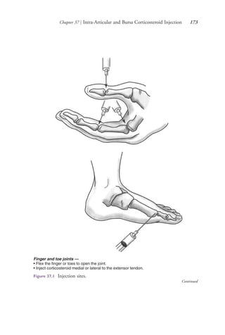 Chapter 37 | Intra-Articular and Bursa Corticosteroid Injection 173
Finger and toe joints —
• Flex the finger or toes to open the joint.
• Inject corticosteroid medial or lateral to the extensor tendon.
Figure 37.1 Injection sites.
Continued
4206_Chapter 2_0121-0204.indd 1734206_Chapter 2_0121-0204.indd 173 12/24/2014 2:01:30 PM12/24/2014 2:01:30 PM
Process CyanProcess CyanProcess MagentaProcess MagentaProcess YellowProcess YellowProcess BlackProcess Black
 