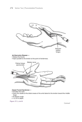 174 Section Two | Musculoskeletal Procedures
Carpal Tunnel Syndrome —
• Dorsiflex the wrist.
• Insert the needle at the distal crease of the wrist lateral to the tendon toward the middle
finger.
• 45-degree angle.
• 1–2 cm in depth.
de Quervains Disease —
• Abduct the thumb.
• Inject parallel to the tendon at the point of tenderness.
Abductor
pollicis
longus
Median nerve
Palmar longus
aponeurosis
Figure 37.1, cont’d
Continued
4206_Chapter 2_0121-0204.indd 1744206_Chapter 2_0121-0204.indd 174 12/24/2014 2:01:30 PM12/24/2014 2:01:30 PM
Process CyanProcess CyanProcess MagentaProcess MagentaProcess YellowProcess YellowProcess BlackProcess Black
 