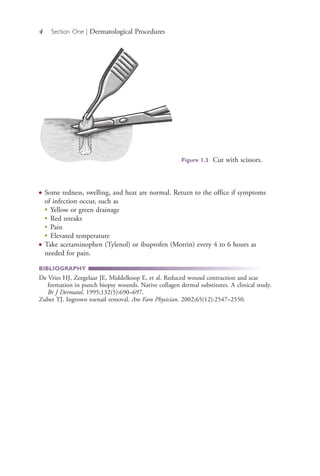 4 Section One | Dermatological Procedures
● Some redness, swelling, and heat are normal. Return to the office if symptoms
of infection occur, such as
●
Yellow or green drainage
●
Red streaks
●
Pain
●
Elevated temperature
● Take acetaminophen (Tylenol) or ibuprofen (Motrin) every 4 to 6 hours as
needed for pain.
BIBLIOGRAPHY
De Vries HJ, Zeegelaar JE, Middelkoop E, et al. Reduced wound contraction and scar
formation in punch biopsy wounds. Native collagen dermal substitutes. A clinical study.
Br J Dermatol. 1995;132(5):690–697.
Zuber TJ. Ingrown toenail removal. Am Fam Physician. 2002;65(12):2547–2550.
Figure 1.3 Cut with scissors.
4206_Chapter 1_0001-0120.indd 44206_Chapter 1_0001-0120.indd 4 12/24/2014 2:01:14 PM12/24/2014 2:01:14 PM
Process CyanProcess CyanProcess MagentaProcess MagentaProcess YellowProcess YellowProcess BlackProcess Black
 