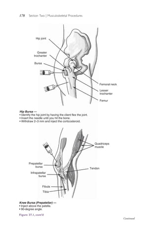 178 Section Two | Musculoskeletal Procedures
Hip Bursa —
• Identify the hip joint by having the client flex the joint.
• Insert the needle until you hit the bone.
• Withdraw 2–3 mm and inject the corticosteroid.
Knee Bursa (Prepatellar) —
• Inject above the patella.
• 90-degree angle.
Hip joint
Greater
trochanter
Bursa
Femoral neck
Quadriceps
muscle
Tendon
Lesser
trochanter
Femur
Prepatellar
bursa
Infrapatellar
bursa
Fibula
Tibia
Figure 37.1, cont’d
Continued
4206_Chapter 2_0121-0204.indd 1784206_Chapter 2_0121-0204.indd 178 12/24/2014 2:01:31 PM12/24/2014 2:01:31 PM
Process CyanProcess CyanProcess MagentaProcess MagentaProcess YellowProcess YellowProcess BlackProcess Black
 
