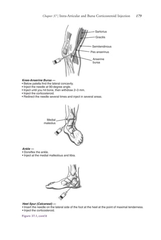 Chapter 37 | Intra-Articular and Bursa Corticosteroid Injection 179
Knee-Anserine Bursa —
• Below patella find the lateral concavity.
• Inject the needle at 90-degree angle.
• Inject until you hit bone, then withdraw 2–3 mm.
• Inject the corticosteroid.
• Redirect the needle several times and inject in several areas.
Ankle —
• Dorsiflex the ankle.
• Inject at the medial malleolous and tibia.
Heel Spur (Calcaneal) —
• Insert the needle on the lateral side of the foot at the heel at the point of maximal tenderness.
• Inject the corticosteroid.
Sartorius
Gracilis
Semitendinous
Pes anserinus
Anserine
bursa
Medial
maleolus
Figure 37.1, cont’d
4206_Chapter 2_0121-0204.indd 1794206_Chapter 2_0121-0204.indd 179 12/24/2014 2:01:31 PM12/24/2014 2:01:31 PM
Process CyanProcess CyanProcess MagentaProcess MagentaProcess YellowProcess YellowProcess BlackProcess Black
 