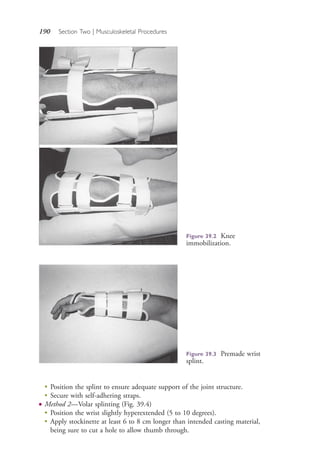 190 Section Two | Musculoskeletal Procedures
Figure 39.2 Knee
immobilization.
Figure 39.3 Premade wrist
splint.
●
Position the splint to ensure adequate support of the joint structure.
●
Secure with self-adhering straps.
● Method 2—Volar splinting (Fig. 39.4)
●
Position the wrist slightly hyperextended (5 to 10 degrees).
●
Apply stockinette at least 6 to 8 cm longer than intended casting material,
being sure to cut a hole to allow thumb through.
4206_Chapter 2_0121-0204.indd 1904206_Chapter 2_0121-0204.indd 190 12/24/2014 2:01:31 PM12/24/2014 2:01:31 PM
Process CyanProcess CyanProcess MagentaProcess MagentaProcess YellowProcess YellowProcess BlackProcess Black
 