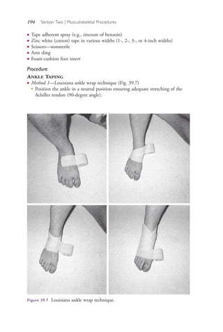 194 Section Two | Musculoskeletal Procedures
● Tape adherent spray (e.g., tincture of benzoin)
● Zinc white (cotton) tape in various widths (1-, 2-, 3-, or 4-inch widths)
● Scissors—nonsterile
● Arm sling
● Foam-cushion foot insert
Procedure
ANKLE TAPING
● Method 1—Louisiana ankle wrap technique (Fig. 39.7)
●
Position the ankle in a neutral position ensuring adequate stretching of the
Achilles tendon (90-degree angle).
Figure 39.7 Louisiana ankle wrap technique.
4206_Chapter 2_0121-0204.indd 1944206_Chapter 2_0121-0204.indd 194 12/24/2014 2:01:32 PM12/24/2014 2:01:32 PM
Process CyanProcess CyanProcess MagentaProcess MagentaProcess YellowProcess YellowProcess BlackProcess Black
 