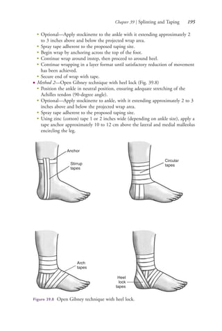 Chapter 39 | Splinting and Taping 195
●
Optional—Apply stockinette to the ankle with it extending approximately 2
to 3 inches above and below the projected wrap area.
●
Spray tape adherent to the proposed taping site.
●
Begin wrap by anchoring across the top of the foot.
●
Continue wrap around instep, then proceed to around heel.
●
Continue wrapping in a layer format until satisfactory reduction of movement
has been achieved.
●
Secure end of wrap with tape.
● Method 2—Open Gibney technique with heel lock (Fig. 39.8)
●
Position the ankle in neutral position, ensuring adequate stretching of the
Achilles tendon (90-degree angle).
●
Optional—Apply stockinette to ankle, with it extending approximately 2 to 3
inches above and below the projected wrap area.
●
Spray tape adherent to the proposed taping site.
●
Using zinc (cotton) tape 1 or 2 inches wide (depending on ankle size), apply a
tape anchor approximately 10 to 12 cm above the lateral and medial malleolus
encircling the leg.
Anchor
Stirrup
tapes
Circular
tapes
Heel
lock
tapes
Arch
tapes
Figure 39.8 Open Gibney technique with heel lock.
4206_Chapter 2_0121-0204.indd 1954206_Chapter 2_0121-0204.indd 195 12/24/2014 2:01:32 PM12/24/2014 2:01:32 PM
Process CyanProcess CyanProcess MagentaProcess MagentaProcess YellowProcess YellowProcess BlackProcess Black
 