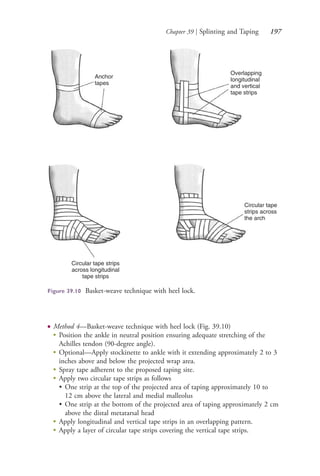 Chapter 39 | Splinting and Taping 197
● Method 4—Basket-weave technique with heel lock (Fig. 39.10)
●
Position the ankle in neutral position ensuring adequate stretching of the
Achilles tendon (90-degree angle).
●
Optional—Apply stockinette to ankle with it extending approximately 2 to 3
inches above and below the projected wrap area.
●
Spray tape adherent to the proposed taping site.
●
Apply two circular tape strips as follows
• One strip at the top of the projected area of taping approximately 10 to
12 cm above the lateral and medial malleolus
• One strip at the bottom of the projected area of taping approximately 2 cm
above the distal metatarsal head
●
Apply longitudinal and vertical tape strips in an overlapping pattern.
●
Apply a layer of circular tape strips covering the vertical tape strips.
Anchor
tapes
Overlapping
longitudinal
and vertical
tape strips
Circular tape
strips across
the arch
Circular tape strips
across longitudinal
tape strips
Figure 39.10 Basket-weave technique with heel lock.
4206_Chapter 2_0121-0204.indd 1974206_Chapter 2_0121-0204.indd 197 12/24/2014 2:01:32 PM12/24/2014 2:01:32 PM
Process CyanProcess CyanProcess MagentaProcess MagentaProcess YellowProcess YellowProcess BlackProcess Black
 