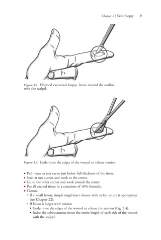 Chapter 2 | Skin Biopsy 9
● Pull tissue as you excise just below full thickness of the tissue.
● Start at one corner and work to the center.
● Go to the other corner and work toward the center.
● Put all excised tissue in a container of 10% formalin.
● Closure
●
If a small lesion, simple single-layer closure with nylon suture is appropriate
(see Chapter 22).
●
If lesion is larger with tension
• Undermine the edges of the wound to release the tension (Fig. 2.4).
• Incise the subcutaneous tissue the entire length of each side of the wound
with the scalpel.
Figure 2.3 Elliptical excisional biopsy. Incise around the outline
with the scalpel.
Figure 2.4 Undermine the edges of the wound to release tension.
4206_Chapter 1_0001-0120.indd 94206_Chapter 1_0001-0120.indd 9 12/24/2014 2:01:14 PM12/24/2014 2:01:14 PM
Process CyanProcess CyanProcess MagentaProcess MagentaProcess YellowProcess YellowProcess BlackProcess Black
 