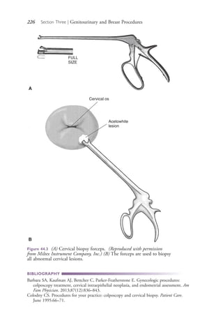 226 Section Three | Genitourinary and Breast Procedures
Figure 44.3 (A) Cervical biopsy forceps. (Reproduced with permission
from Miltex Instrument Company, Inc.) (B) The forceps are used to biopsy
all abnormal cervical lesions.
FULL
SIZE
A
Cervical os
Acetowhite
lesion
B
BIBLIOGRAPHY
Barbara SA, Kaufman AJ, Bettcher C, Parker-Featherstone E. Gynecologic procedures:
colposcopy treatment, cervical intraepithelial neoplasia, and endometrial assessment. Am
Fam Physician. 2013;87(12):836–843.
Colodny CS. Procedures for your practice: colposcopy and cervical biopsy. Patient Care.
June 1995:66–71.
4206_Chapter 3_0205-0312.indd 2264206_Chapter 3_0205-0312.indd 226 12/24/2014 2:01:41 PM12/24/2014 2:01:41 PM
Process CyanProcess CyanProcess MagentaProcess MagentaProcess YellowProcess YellowProcess BlackProcess Black
 