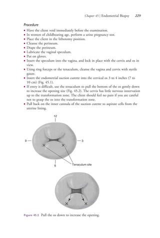 Chapter 45 | Endometrial Biopsy 229
Procedure
● Have the client void immediately before the examination.
● In women of childbearing age, perform a urine pregnancy test.
● Place the client in the lithotomy position.
● Cleanse the perineum.
● Drape the perineum.
● Lubricate the vaginal speculum.
● Put on gloves.
● Insert the speculum into the vagina, and lock in place with the cervix and os in
view.
● Using ring forceps or the tenaculum, cleanse the vagina and cervix with sterile
gauze.
● Insert the endometrial suction curette into the cervical os 3 to 4 inches (7 to
10 cm) (Fig. 45.1).
● If entry is difficult, use the tenaculum to pull the bottom of the os gently down
to increase the opening size (Fig. 45.2). The cervix has little nervous innervation
up to the transformation zone. The client should feel no pain if you are careful
not to grasp the os into the transformation zone.
● Pull back on the inner cannula of the suction curette to aspirate cells from the
uterine lining.
Tenaculum site
3
6
9
12
Figure 45.2 Pull the os down to increase the opening.
4206_Chapter 3_0205-0312.indd 2294206_Chapter 3_0205-0312.indd 229 12/24/2014 2:01:41 PM12/24/2014 2:01:41 PM
Process CyanProcess CyanProcess MagentaProcess MagentaProcess YellowProcess YellowProcess BlackProcess Black
 