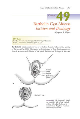 Chapter 49 | Bartholin Cyst Abscess 243
Chapter
49Bartholin Cyst Abscess
Incision and Drainage
Margaret R. Colyar
CPT Code
56420 Incision and drainage of Bartholin’s gland abscess
56740 Excision of Bartholin’s gland or cyst
Bartholinitis is inflammation of one or both of the Bartholin’s glands at the opening
of the vagina (Fig. 49.1). Obstruction of the main duct of these glands causes reten-
tion of secretions and dilation of the gland. Incision and drainage of abscessed
Figure 49.1 (A) Bartholin’s glands
are on either side of the vaginal
orifice. (B) A Bartholin’s cyst
occurs when the gland becomes
inflamed or infected.
Bartholin's
glands
Vagina
Labia
Urethra
A
Bartholin's cyst
B
4206_Chapter 3_0205-0312.indd 2434206_Chapter 3_0205-0312.indd 243 12/24/2014 2:01:42 PM12/24/2014 2:01:42 PM
Process CyanProcess CyanProcess MagentaProcess MagentaProcess YellowProcess YellowProcess BlackProcess Black
 