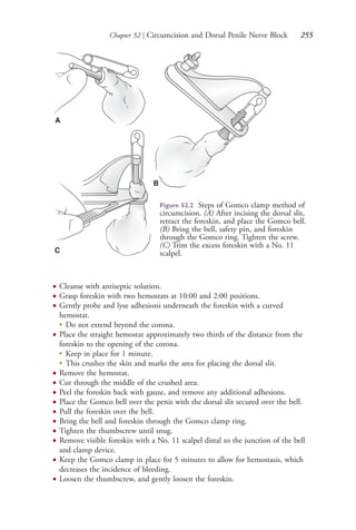 Chapter 52 | Circumcision and Dorsal Penile Nerve Block 255
● Cleanse with antiseptic solution.
● Grasp foreskin with two hemostats at 10:00 and 2:00 positions.
● Gently probe and lyse adhesions underneath the foreskin with a curved
hemostat.
●
Do not extend beyond the corona.
● Place the straight hemostat approximately two thirds of the distance from the
foreskin to the opening of the corona.
●
Keep in place for 1 minute.
●
This crushes the skin and marks the area for placing the dorsal slit.
● Remove the hemostat.
● Cut through the middle of the crushed area.
● Peel the foreskin back with gauze, and remove any additional adhesions.
● Place the Gomco bell over the penis with the dorsal slit secured over the bell.
● Pull the foreskin over the bell.
● Bring the bell and foreskin through the Gomco clamp ring.
● Tighten the thumbscrew until snug.
● Remove visible foreskin with a No. 11 scalpel distal to the junction of the bell
and clamp device.
● Keep the Gomco clamp in place for 5 minutes to allow for hemostasis, which
decreases the incidence of bleeding.
● Loosen the thumbscrew, and gently loosen the foreskin.
Figure 52.2 Steps of Gomco clamp method of
circumcision. (A) After incising the dorsal slit,
retract the foreskin, and place the Gomco bell.
(B) Bring the bell, safety pin, and foreskin
through the Gomco ring. Tighten the screw.
(C) Trim the excess foreskin with a No. 11
scalpel.
A
B
C
4206_Chapter 3_0205-0312.indd 2554206_Chapter 3_0205-0312.indd 255 12/24/2014 2:01:42 PM12/24/2014 2:01:42 PM
Process CyanProcess CyanProcess MagentaProcess MagentaProcess YellowProcess YellowProcess BlackProcess Black
 