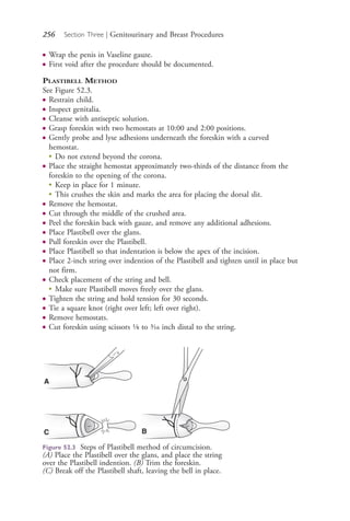 256 Section Three | Genitourinary and Breast Procedures
● Wrap the penis in Vaseline gauze.
● First void after the procedure should be documented.
PLASTIBELL METHOD
See Figure 52.3.
● Restrain child.
● Inspect genitalia.
● Cleanse with antiseptic solution.
● Grasp foreskin with two hemostats at 10:00 and 2:00 positions.
● Gently probe and lyse adhesions underneath the foreskin with a curved
hemostat.
●
Do not extend beyond the corona.
● Place the straight hemostat approximately two-thirds of the distance from the
foreskin to the opening of the corona.
●
Keep in place for 1 minute.
●
This crushes the skin and marks the area for placing the dorsal slit.
● Remove the hemostat.
● Cut through the middle of the crushed area.
● Peel the foreskin back with gauze, and remove any additional adhesions.
● Place Plastibell over the glans.
● Pull foreskin over the Plastibell.
● Place Plastibell so that indentation is below the apex of the incision.
● Place 2-inch string over indention of the Plastibell and tighten until in place but
not firm.
● Check placement of the string and bell.
●
Make sure Plastibell moves freely over the glans.
● Tighten the string and hold tension for 30 seconds.
● Tie a square knot (right over left; left over right).
● Remove hemostats.
● Cut foreskin using scissors 1⁄8 to 3⁄16 inch distal to the string.
Figure 52.3 Steps of Plastibell method of circumcision.
(A) Place the Plastibell over the glans, and place the string
over the Plastibell indention. (B) Trim the foreskin.
(C) Break off the Plastibell shaft, leaving the bell in place.
A
C B
4206_Chapter 3_0205-0312.indd 2564206_Chapter 3_0205-0312.indd 256 12/24/2014 2:01:42 PM12/24/2014 2:01:42 PM
Process CyanProcess CyanProcess MagentaProcess MagentaProcess YellowProcess YellowProcess BlackProcess Black
 