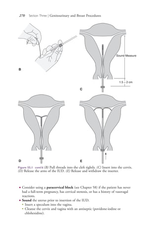 270 Section Three | Genitourinary and Breast Procedures
● Consider using a paracervical block (see Chapter 58) if the patient has never
had a full-term pregnancy, has cervical stenosis, or has a history of vasovagal
reactions.
● Sound the uterus prior to insertion of the IUD.
●
Insert a speculum into the vagina.
●
Cleanse the cervix and vagina with an antiseptic (povidone-iodine or
chlohexidine).
B
Sound Measure
1.5 – 2 cm
C
D E
Figure 55.1 cont’d (B) Pull threads into the cleft tightly. (C) Insert into the cervix.
(D) Release the arms of the IUD. (E) Release and withdraw the inserter.
4206_Chapter 3_0205-0312.indd 2704206_Chapter 3_0205-0312.indd 270 12/24/2014 2:01:43 PM12/24/2014 2:01:43 PM
Process CyanProcess CyanProcess MagentaProcess MagentaProcess YellowProcess YellowProcess BlackProcess Black
 