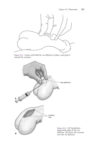 Chapter 61 | Vasectomy 291
Figure 61.1 Locate and hold the vas deferens in place, and push it
toward the scrotum.
Figure 61.2 (A) Anesthetize
along both sides of the vas
deferens. (B) Incise the scrotum
over the vas deferens.
Vas deferens
A
Incision
line
B
4206_Chapter 3_0205-0312.indd 2914206_Chapter 3_0205-0312.indd 291 12/24/2014 2:01:44 PM12/24/2014 2:01:44 PM
Process CyanProcess CyanProcess MagentaProcess MagentaProcess YellowProcess YellowProcess BlackProcess Black
 
