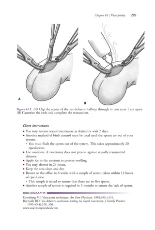 Chapter 61 | Vasectomy 293
Figure 61.5 (A) Clip the center of the vas deferens halfway through in two areas 1 cm apart.
(B) Cauterize the ends and complete the transection.
A
B
Client Instructions
● You may resume sexual intercourse as desired or wait 7 days.
● Another method of birth control must be used until the sperm are out of your
system.
●
You must flush the sperm out of the system. This takes approximately 20
ejaculations.
● Use condoms. A vasectomy does not protect against sexually transmitted
diseases.
● Apply ice to the scrotum to prevent swelling.
● You may shower in 24 hours.
● Keep the area clean and dry.
● Return to the office in 6 weeks with a sample of semen taken within 12 hours
of ejaculation.
●
This sample is tested to ensure that there are no live sperm.
● Another sample of semen is required in 3 months to ensure the lack of sperm.
BIBLIOGRAPHY
Greenberg MJ. Vasectomy technique. Am Fam Physician. 1989;39(1):131.
Reynolds RD. Vas deferens occlusion during no scapel vasectomy. J Family Practice.
1995:40(4):328, 330.
www.vasectomymedical.com
4206_Chapter 3_0205-0312.indd 2934206_Chapter 3_0205-0312.indd 293 12/24/2014 2:01:44 PM12/24/2014 2:01:44 PM
Process CyanProcess CyanProcess MagentaProcess MagentaProcess YellowProcess YellowProcess BlackProcess Black
 