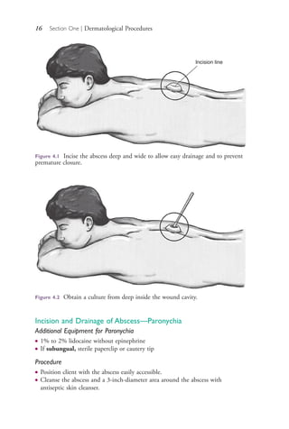 16 Section One | Dermatological Procedures
Incision and Drainage of Abscess—Paronychia
Additional Equipment for Paronychia
● 1% to 2% lidocaine without epinephrine
● If subungual, sterile paperclip or cautery tip
Procedure
● Position client with the abscess easily accessible.
● Cleanse the abscess and a 3-inch-diameter area around the abscess with
antiseptic skin cleanser.
Figure 4.1 Incise the abscess deep and wide to allow easy drainage and to prevent
premature closure.
Incision line
Figure 4.2 Obtain a culture from deep inside the wound cavity.
4206_Chapter 1_0001-0120.indd 164206_Chapter 1_0001-0120.indd 16 12/24/2014 2:01:15 PM12/24/2014 2:01:15 PM
Process CyanProcess CyanProcess MagentaProcess MagentaProcess YellowProcess YellowProcess BlackProcess Black
 
