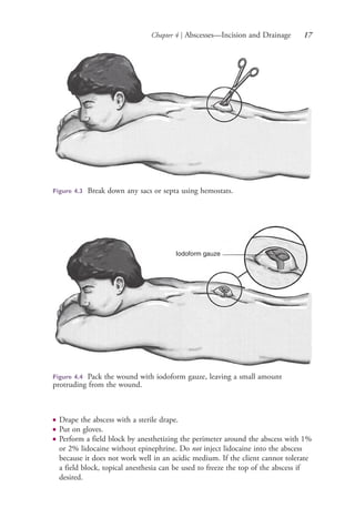 Chapter 4 | Abscesses—Incision and Drainage 17
● Drape the abscess with a sterile drape.
● Put on gloves.
● Perform a field block by anesthetizing the perimeter around the abscess with 1%
or 2% lidocaine without epinephrine. Do not inject lidocaine into the abscess
because it does not work well in an acidic medium. If the client cannot tolerate
a field block, topical anesthesia can be used to freeze the top of the abscess if
desired.
Figure 4.3 Break down any sacs or septa using hemostats.
Iodoform gauze
Figure 4.4 Pack the wound with iodoform gauze, leaving a small amount
protruding from the wound.
4206_Chapter 1_0001-0120.indd 174206_Chapter 1_0001-0120.indd 17 12/24/2014 2:01:15 PM12/24/2014 2:01:15 PM
Process CyanProcess CyanProcess MagentaProcess MagentaProcess YellowProcess YellowProcess BlackProcess Black
 