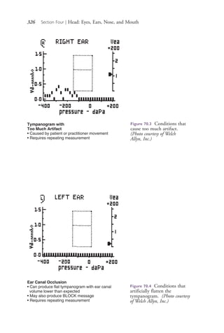 326 Section Four | Head: Eyes, Ears, Nose, and Mouth
Tympanogram with
Too Much Artifact
• Caused by patient or practitioner movement
• Requires repeating measurement
Figure 70.3 Conditions that
cause too much artifact.
(Photo courtesy of Welch
Allyn, Inc.)
Ear Canal Occlusion
• Can produce flat tympanogram with ear canal
volume lower than expected
• May also produce BLOCK message
• Requires repeating measurement
Figure 70.4 Conditions that
artificially flatten the
tympanogram. (Photo courtesy
of Welch Allyn, Inc.)
4206_Chapter 4_0313-0402.indd 3264206_Chapter 4_0313-0402.indd 326 12/24/2014 2:01:51 PM12/24/2014 2:01:51 PM
Process CyanProcess CyanProcess MagentaProcess MagentaProcess YellowProcess YellowProcess BlackProcess Black
 