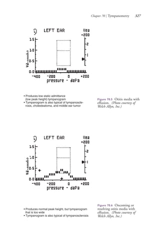 Chapter 70 | Tympanometry 327
• Produces low static admittance
(low peak height) tympanogram
• Tympanogram is also typical of tympanoscle-
rosis, cholesteatoma, and middle ear tumor
Figure 70.5 Otitis media with
effusion. (Photo courtesy of
Welch Allyn, Inc.)
• Produces normal peak height, but tympanogram
that is too wide
• Tympanogram is also typical of tympanosclerosis
Figure 70.6 Oncoming or
resolving otitis media with
effusion. (Photo courtesy of
Welch Allyn, Inc.)
4206_Chapter 4_0313-0402.indd 3274206_Chapter 4_0313-0402.indd 327 12/24/2014 2:01:51 PM12/24/2014 2:01:51 PM
Process CyanProcess CyanProcess MagentaProcess MagentaProcess YellowProcess YellowProcess BlackProcess Black
 