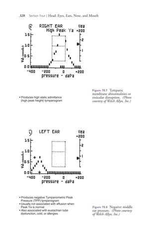 328 Section Four | Head: Eyes, Ears, Nose, and Mouth
• Produces high static admittance
(high peak height) tympanogram
Figure 70.7 Tympanic
membrane abnormalities or
ossicular disruption. (Photo
courtesy of Welch Allyn, Inc.)
• Produces negative Tympanometric Peak
Pressure (TPP) tympanogram
• Usually not associated with effusion when
Peak Ya is normal
• Also associated with eustachian tube
dysfunction, cold, or allergies
Figure 70.8 Negative middle
ear pressure. (Photo courtesy
of Welch Allyn, Inc.)
4206_Chapter 4_0313-0402.indd 3284206_Chapter 4_0313-0402.indd 328 12/24/2014 2:01:51 PM12/24/2014 2:01:51 PM
Process CyanProcess CyanProcess MagentaProcess MagentaProcess YellowProcess YellowProcess BlackProcess Black
 
