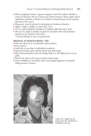 Chapter 72 | Corneal Abrasion and Foreign Body Removal 339
● When completed, initiate a vigorous irrigation with 0.9% sodium chloride to
remove all dye from the eye to lessen any further irritation. Always apply topical
ophthalmic antibiotic of choice if an abrasion is found because of the avascular
character of the cornea.
● Document—may be pictorial or description of location of abrasion.
● Apply a single or double eye patch (Fig. 72.1).
● Use of a patch should be considered in children older than age 5 years.
● The use of a single or double eye patch for all adults with corneal abrasion
depends on the comfort of the client.
●
Contraindicated in cases of conjunctivitis
REMOVAL OF FOREIGN BODY—EYE
● Have the client lie in a comfortable supine position.
● Put on gloves.
● Instill one to two drops of ophthalmic anesthetic.
● Spread the eyelids apart with the thumb and index finger.
● Have head positioned so that the foreign body is at the highest point on eye
globe.
● Instruct the client to fix a gaze toward a certain point.
● If not embedded, use moistened sterile cotton-tipped applicator with gentle
rolling motion to remove.
Figure 72.1 Apply an eye
patch after the antibiotic is
instilled in the eye.
4206_Chapter 4_0313-0402.indd 3394206_Chapter 4_0313-0402.indd 339 12/24/2014 2:01:52 PM12/24/2014 2:01:52 PM
Process CyanProcess CyanProcess MagentaProcess MagentaProcess YellowProcess YellowProcess BlackProcess Black
 