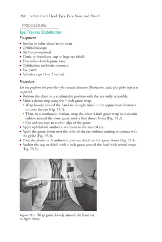 350 Section Four | Head: Eyes, Ears, Nose, and Mouth
PROCEDURE
Eye Trauma Stabilization
Equipment
● Snellen or other visual acuity chart
● Ophthalmoscope
● Slit lamp—optional
● Plastic or Styrofoam cup or large eye shield
● Two rolls—4-inch gauze wrap
● Ophthalmic antibiotic ointment
● Eye patch
● Adhesive tape (1 or 2 inches)
Procedure
Do not perform the procedure for corneal abrasion (fluorescein stain) if a globe injury is
suspected.
● Position the client in a comfortable position with the eye easily accessible.
● Make a donut ring using the 4-inch gauze wrap.
●
Wrap loosely around the hand six to eight times in the approximate diameter
to cover the eye (Fig. 75.1).
●
Then, in a continuous motion, wrap the other 4-inch gauze wrap in a circular
fashion around the loose gauze until a firm donut forms (Fig. 75.2).
●
Cut and use tape to anchor edge of the gauze.
● Apply ophthalmic antibiotic ointment to the injured eye.
● Apply the gauze donut over the orbit of the eye without coming in contact with
the globe (Fig. 75.3).
● Place the plastic or Styrofoam cup or eye shield on the gauze donut (Fig. 75.4).
● Anchor the cup or shield with 4-inch gauze around the head with several wraps
(Fig. 75.5).
Figure 75.1 Wrap gauze loosely around the hand six
to eight times.
4206_Chapter 4_0313-0402.indd 3504206_Chapter 4_0313-0402.indd 350 12/24/2014 2:01:53 PM12/24/2014 2:01:53 PM
Process CyanProcess CyanProcess MagentaProcess MagentaProcess YellowProcess YellowProcess BlackProcess Black
 