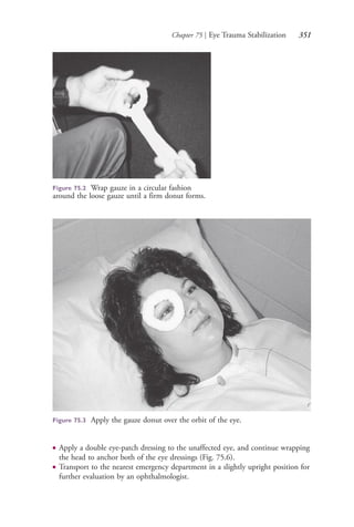Chapter 75 | Eye Trauma Stabilization 351
Figure 75.2 Wrap gauze in a circular fashion
around the loose gauze until a firm donut forms.
Figure 75.3 Apply the gauze donut over the orbit of the eye.
● Apply a double eye-patch dressing to the unaffected eye, and continue wrapping
the head to anchor both of the eye dressings (Fig. 75.6).
● Transport to the nearest emergency department in a slightly upright position for
further evaluation by an ophthalmologist.
4206_Chapter 4_0313-0402.indd 3514206_Chapter 4_0313-0402.indd 351 12/24/2014 2:01:53 PM12/24/2014 2:01:53 PM
Process CyanProcess CyanProcess MagentaProcess MagentaProcess YellowProcess YellowProcess BlackProcess Black
 