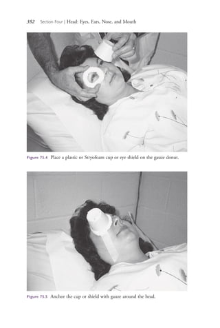 352 Section Four | Head: Eyes, Ears, Nose, and Mouth
Figure 75.4 Place a plastic or Stryofoam cup or eye shield on the gauze donut.
Figure 75.5 Anchor the cup or shield with gauze around the head.
4206_Chapter 4_0313-0402.indd 3524206_Chapter 4_0313-0402.indd 352 12/24/2014 2:01:53 PM12/24/2014 2:01:53 PM
Process CyanProcess CyanProcess MagentaProcess MagentaProcess YellowProcess YellowProcess BlackProcess Black
 