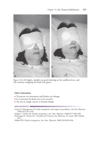 Chapter 75 | Eye Trauma Stabilization 353
Client Instructions
● To prevent eye movement and further eye damage
● It is necessary for both eyes to be covered.
● Try not to cough, sneeze, or breathe deeply.
BIBLIOGRAPHY
Garcia G. Management of ocular emergencies and urgent eye problems. Am Fam Physician.
1996;53(2):347–356.
Hodge C, Lawless M. Ocular emergencies. Am. Fam. Physician. 2008;37(7):506–509.
Pfenninger JL, Fowler GC. Procedures for Primary Care Physicians. St. Louis, MO: Mosby;
2011.
Pokhrel PK. Ocular emergencies. Am. Fam. Physician. 2008;76(6):829–836.
Figure 75.6 (A) Apply a double eye-patch dressing to the unaffected eye, and
(B) continue wrapping the head with gauze.
A B
4206_Chapter 4_0313-0402.indd 3534206_Chapter 4_0313-0402.indd 353 12/24/2014 2:01:53 PM12/24/2014 2:01:53 PM
Process CyanProcess CyanProcess MagentaProcess MagentaProcess YellowProcess YellowProcess BlackProcess Black
 
