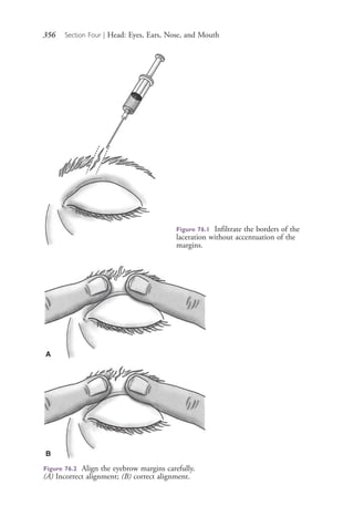 356 Section Four | Head: Eyes, Ears, Nose, and Mouth
Figure 76.1 Infiltrate the borders of the
laceration without accentuation of the
margins.
Figure 76.2 Align the eyebrow margins carefully.
(A) Incorrect alignment; (B) correct alignment.
A
B
4206_Chapter 4_0313-0402.indd 3564206_Chapter 4_0313-0402.indd 356 12/24/2014 2:01:53 PM12/24/2014 2:01:53 PM
Process CyanProcess CyanProcess MagentaProcess MagentaProcess YellowProcess YellowProcess BlackProcess Black
 