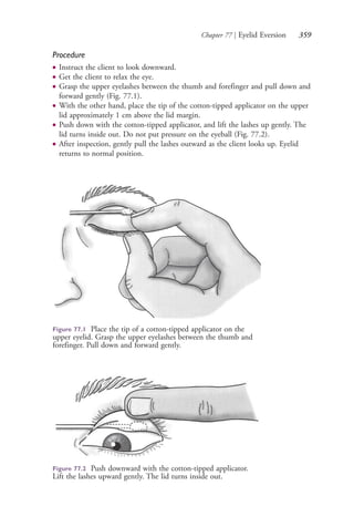 Chapter 77 | Eyelid Eversion 359
Procedure
● Instruct the client to look downward.
● Get the client to relax the eye.
● Grasp the upper eyelashes between the thumb and forefinger and pull down and
forward gently (Fig. 77.1).
● With the other hand, place the tip of the cotton-tipped applicator on the upper
lid approximately 1 cm above the lid margin.
● Push down with the cotton-tipped applicator, and lift the lashes up gently. The
lid turns inside out. Do not put pressure on the eyeball (Fig. 77.2).
● After inspection, gently pull the lashes outward as the client looks up. Eyelid
returns to normal position.
Figure 77.1 Place the tip of a cotton-tipped applicator on the
upper eyelid. Grasp the upper eyelashes between the thumb and
forefinger. Pull down and forward gently.
Figure 77.2 Push downward with the cotton-tipped applicator.
Lift the lashes upward gently. The lid turns inside out.
4206_Chapter 4_0313-0402.indd 3594206_Chapter 4_0313-0402.indd 359 12/24/2014 2:01:53 PM12/24/2014 2:01:53 PM
Process CyanProcess CyanProcess MagentaProcess MagentaProcess YellowProcess YellowProcess BlackProcess Black
 