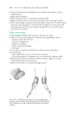 362 Section Four | Head: Eyes, Ears, Nose, and Mouth
● Using curved hemostats and digital pressure, explore the wound to remove
remaining clots.
● Apply topical antibiotic.
● Roll 2-inch gauze into 1½-inch-diameter pressure rolls.
● Apply a pressure roll over incision on each side of the ear and tape securely.
● If you cannot apply the pressure roll as described, using 4-0 or 5-0 nylon suture,
insert the suture through one end of the roll, through the ear, into gauze roll
on the posterior side of the ear, and back through the ear and anterior gauze
(Fig. 78.2). Tie securely.
Client Instructions
● Take cephalexin (Keflex), 500 mg twice a day for 5 to 7 days.
● Observe for signs and symptoms of infection and perichondritis, such as
●
Increase in pain after 24 hours
●
Increase in temperature
●
Redness or swelling
●
Yellow or greenish drainage
●
Foul odor
● If any signs or symptoms of infection are found, return to the office.
● To relieve pain
●
Take Tylenol No. 3 every 4 to 6 hours for 24 hours.
●
Take acetaminophen or ibuprofen every 4 to 6 hours for mild pain relief.
● Bleeding and oozing are normal for the first 24 hours. Apply an ice pack
intermittently to the ear for 24 hours.
● Return to the office in 1 week for dressing removal.
Figure 78.2 (A) Roll 2-inch gauze into ½-inch-diameter
pressure rolls; (B) apply the pressure rolls on both sides of
the ear directly over the expressed hematoma, and suture
in place.
A
B
4206_Chapter 4_0313-0402.indd 3624206_Chapter 4_0313-0402.indd 362 12/24/2014 2:01:54 PM12/24/2014 2:01:54 PM
Process CyanProcess CyanProcess MagentaProcess MagentaProcess YellowProcess YellowProcess BlackProcess Black
 