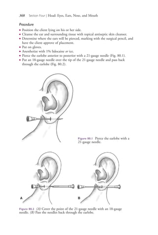368 Section Four | Head: Eyes, Ears, Nose, and Mouth
Procedure
● Position the client lying on his or her side.
● Cleanse the ear and surrounding tissue with topical antiseptic skin cleanser.
● Determine where the ears will be pierced, marking with the surgical pencil, and
have the client approve of placement.
● Put on gloves.
● Anesthetize with 1% lidocaine or ice.
● Pierce the earlobe anterior to posterior with a 21-gauge needle (Fig. 80.1).
● Put an 18-gauge needle over the tip of the 21-gauge needle and pass back
through the earlobe (Fig. 80.2).
Figure 80.1 Pierce the earlobe with a
21-gauge needle.
A B
Figure 80.2 (A) Cover the point of the 21-gauge needle with an 18-gauge
needle. (B) Pass the needles back through the earlobe.
4206_Chapter 4_0313-0402.indd 3684206_Chapter 4_0313-0402.indd 368 12/24/2014 2:01:54 PM12/24/2014 2:01:54 PM
Process CyanProcess CyanProcess MagentaProcess MagentaProcess YellowProcess YellowProcess BlackProcess Black
 