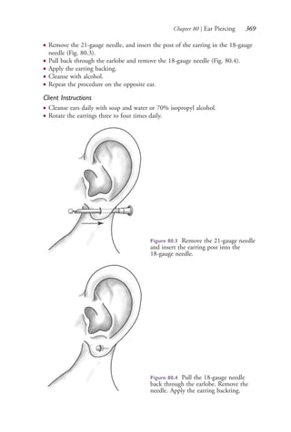 Chapter 80 | Ear Piercing 369
● Remove the 21-gauge needle, and insert the post of the earring in the 18-gauge
needle (Fig. 80.3).
● Pull back through the earlobe and remove the 18-gauge needle (Fig. 80.4).
● Apply the earring backing.
● Cleanse with alcohol.
● Repeat the procedure on the opposite ear.
Client Instructions
● Cleanse ears daily with soap and water or 70% isopropyl alcohol.
● Rotate the earrings three to four times daily.
Figure 80.3 Remove the 21-gauge needle
and insert the earring post into the
18-gauge needle.
Figure 80.4 Pull the 18-gauge needle
back through the earlobe. Remove the
needle. Apply the earring backring.
4206_Chapter 4_0313-0402.indd 3694206_Chapter 4_0313-0402.indd 369 12/24/2014 2:01:54 PM12/24/2014 2:01:54 PM
Process CyanProcess CyanProcess MagentaProcess MagentaProcess YellowProcess YellowProcess BlackProcess Black
 