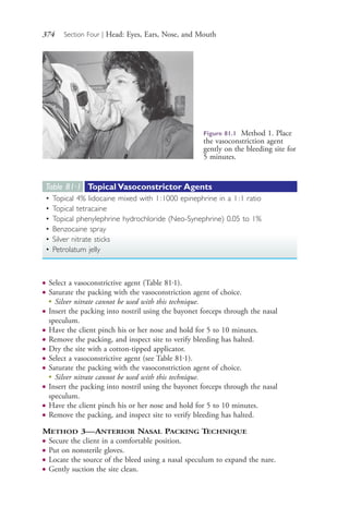 374 Section Four | Head: Eyes, Ears, Nose, and Mouth
● Select a vasoconstrictive agent (Table 81.1).
● Saturate the packing with the vasoconstriction agent of choice.
●
Silver nitrate cannot be used with this technique.
● Insert the packing into nostril using the bayonet forceps through the nasal
speculum.
● Have the client pinch his or her nose and hold for 5 to 10 minutes.
● Remove the packing, and inspect site to verify bleeding has halted.
● Dry the site with a cotton-tipped applicator.
● Select a vasoconstrictive agent (see Table 81.1).
● Saturate the packing with the vasoconstriction agent of choice.
●
Silver nitrate cannot be used with this technique.
● Insert the packing into nostril using the bayonet forceps through the nasal
speculum.
● Have the client pinch his or her nose and hold for 5 to 10 minutes.
● Remove the packing, and inspect site to verify bleeding has halted.
METHOD 3—ANTERIOR NASAL PACKING TECHNIQUE
● Secure the client in a comfortable position.
● Put on nonsterile gloves.
● Locate the source of the bleed using a nasal speculum to expand the nare.
● Gently suction the site clean.
Figure 81.1 Method 1. Place
the vasoconstriction agent
gently on the bleeding site for
5 minutes.
Table 81·1 Topical Vasoconstrictor Agents
• Topical 4% lidocaine mixed with 1:1000 epinephrine in a 1:1 ratio
• Topical tetracaine
• Topical phenylephrine hydrochloride (Neo-Synephrine) 0.05 to 1%
• Benzocaine spray
• Silver nitrate sticks
• Petrolatum jelly
4206_Chapter 4_0313-0402.indd 3744206_Chapter 4_0313-0402.indd 374 12/24/2014 2:01:54 PM12/24/2014 2:01:54 PM
Process CyanProcess CyanProcess MagentaProcess MagentaProcess YellowProcess YellowProcess BlackProcess Black
 