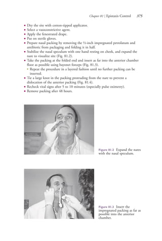 Chapter 81 | Epistaxis Control 375
● Dry the site with cotton-tipped applicator.
● Select a vasoconstrictive agent.
● Apply the fenestrated drape.
● Put on sterile gloves.
● Prepare nasal packing by removing the ½-inch impregnated petrolatum and
antibiotic from packaging and folding it in half.
● Stabilize the nasal speculum with one hand resting on cheek, and expand the
nare to visualize site (Fig. 81.2).
● Take the packing at the folded end and insert as far into the anterior chamber
floor as possible using bayonet forceps (Fig. 81.3).
●
Repeat the procedure in a layered fashion until no further packing can be
inserted.
● Tie a large knot in the packing protruding from the nare to prevent a
dislocation of the anterior packing (Fig. 81.4).
● Recheck vital signs after 5 to 10 minutes (especially pulse oximetry).
● Remove packing after 48 hours.
Figure 81.2 Expand the nares
with the nasal speculum.
Figure 81.3 Insert the
impregnated packing as far as
possible into the anterior
chamber.
4206_Chapter 4_0313-0402.indd 3754206_Chapter 4_0313-0402.indd 375 12/24/2014 2:01:54 PM12/24/2014 2:01:54 PM
Process CyanProcess CyanProcess MagentaProcess MagentaProcess YellowProcess YellowProcess BlackProcess Black
 